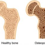 Mencegah-Osteoporosis-1-700x506